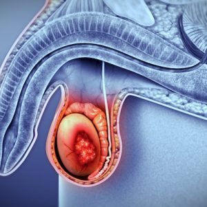 cancer-testiculo