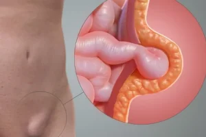 hernia-inguinal