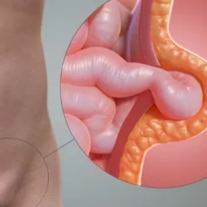 hernia-inguinal